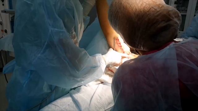 Брахиопластика - пластика рук. Операцию проводит пластический хирург Константинова И.В. смотреть онлайн