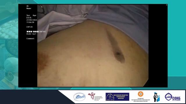 27.05 Сессия А  Нестоличная торакальная хирургия