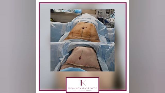 Классическая абдоминопластика с ушиванием диастаза и переносом пупка смотреть онлайн