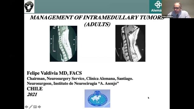 ACNS Webinar - Sept 15 - Post Op Epidural Effusions & Adult Intramedullary Tumors смотреть онлайн