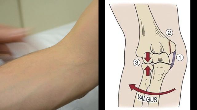 Elbow Valgus and Varus Stress Tests смотреть онлайн