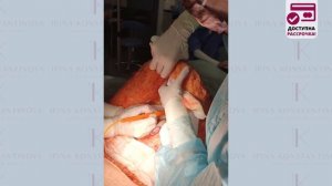 Абдоминопластика - пластика живота. Пластический хирург Константинова Ирина