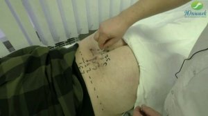 Постановка пиявок на крестец