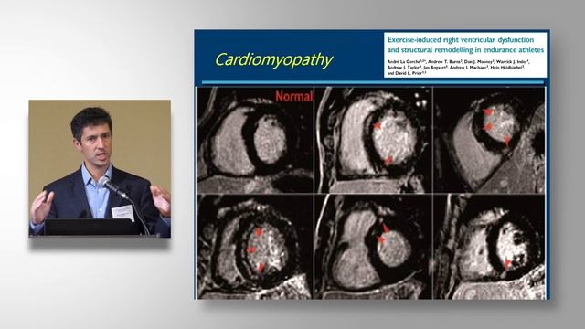 Aaron Baggish, MD, Is Too Much Endurance Exercise Bad for your Heart смотреть онлайн