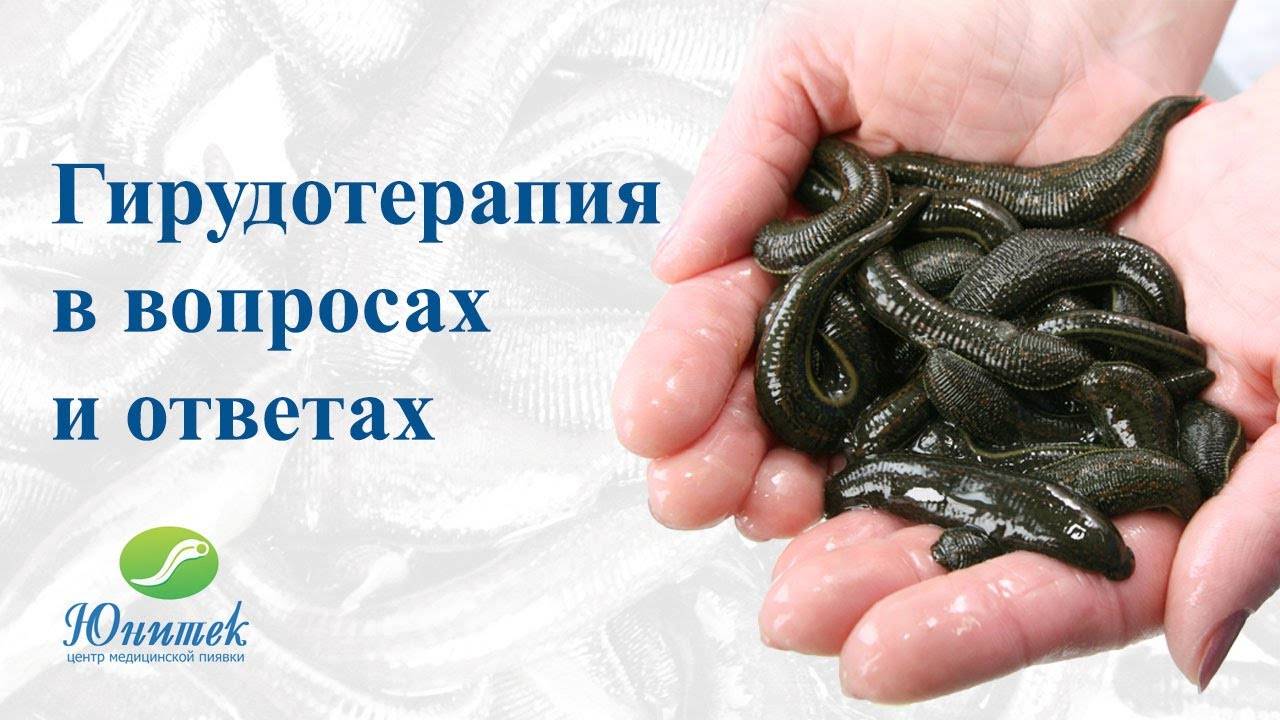 Гирудотерапия в вопросах и ответах