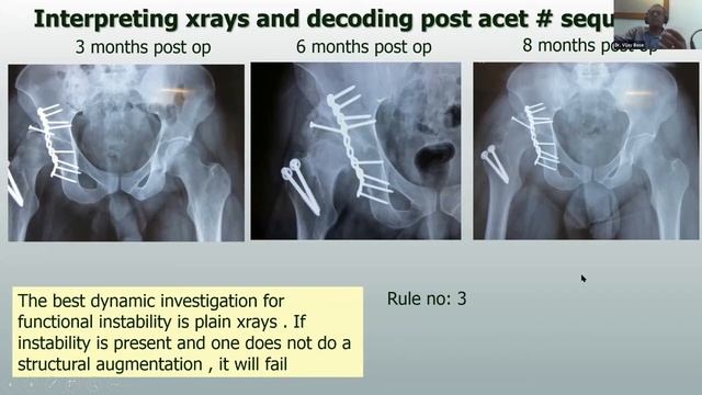 IAA Webinar 8-THR in Post Traumatic Hip смотреть онлайн