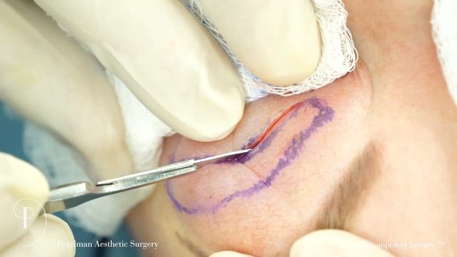 Upper Eyelid Blepharoplasty смотреть онлайн