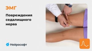 ЭМГ: Диагностика Повреждений Седалищного Нерва