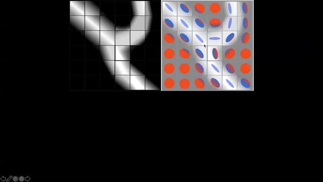 Diffusion Tensor Imaging For Traumatic Brachial Plexus Root Avulsions:  Early Data In 3 Mins (2020)