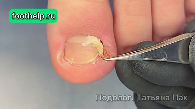 Удаление вросшего ногтя быстро, не больно и никакой реабилитации после 🙌 #подологтатьянапак смотреть онлайн