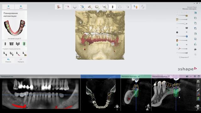 3shape Surgical guide смотреть онлайн