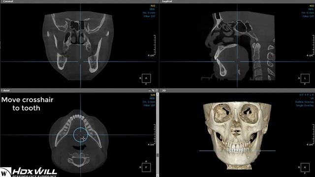 Creating a diagnostic view on OnDemand3D with HDXWILL Dentri α imaging. смотреть онлайн