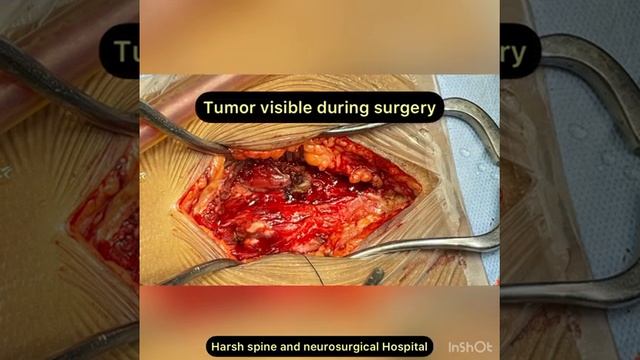 SACRAL BONE TUMOR смотреть онлайн