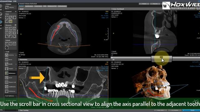 Virtual Implant Treatment Plan Simulation смотреть онлайн