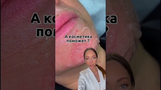Как убрать сосуды на лице ? #купероз смотреть онлайн