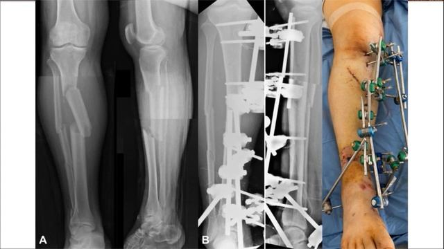 How to Heal Fracture Faster in Hindi| Fracture ke baad kya karein| fracture ka sabse achcha ilaj| смотреть онлайн