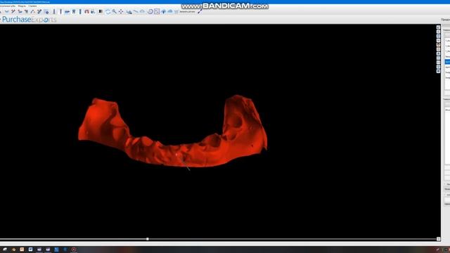 Как планируют операцию имплантации ALL ON 4 смотреть онлайн