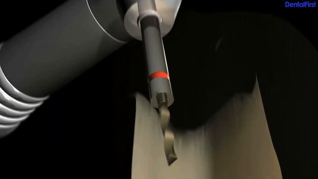 Ваш ключ к успеху - Thermafil ProTaper