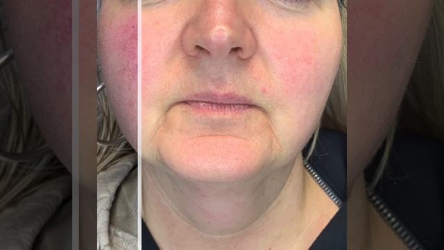 Before & After 1 BroadBand Light Treatment (BBL) смотреть онлайн