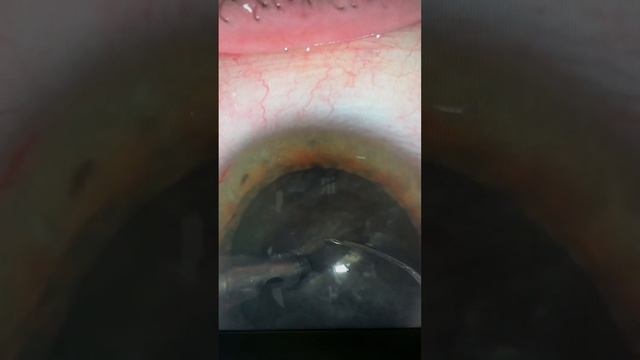 Лечим зрелую бурую катаракту с помощью микротравматичных технологий: Врач Унгурьянов. смотреть онлайн