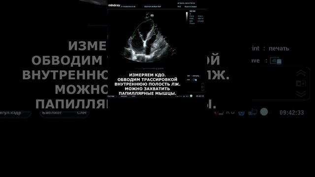 Измеряем фракцию выброса по Симпсону