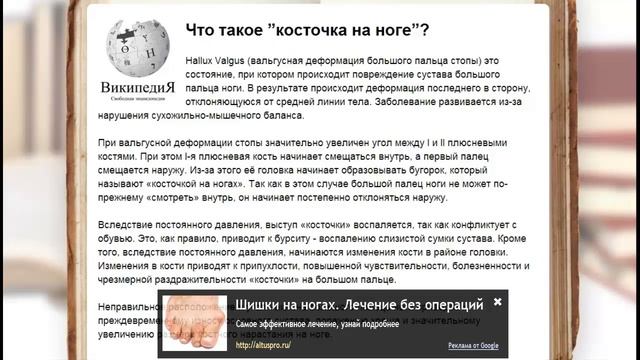варус вальгус / острый приступ подагры