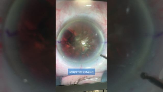 Мультифокальный хрусталик для пациента 88 лет - хорошее зрение без очков. смотреть онлайн