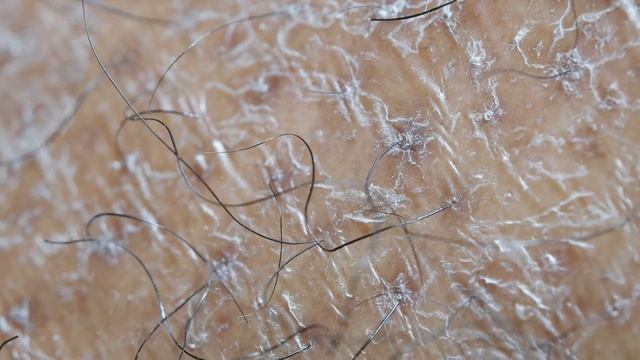 Is It Possible to Go out on a Sunny Day After a Hair Transplant? смотреть онлайн