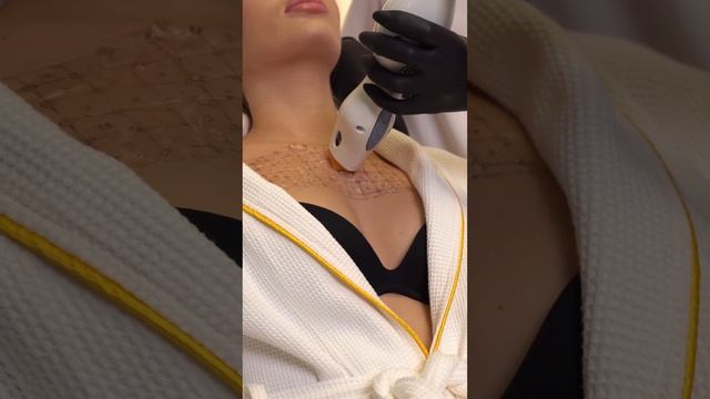 RF-лифтинг Thermage (термаж) смотреть онлайн