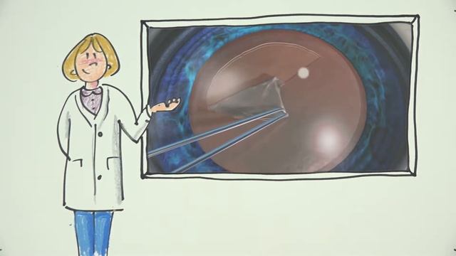 Операция по поводу катаракты от А до Я смотреть онлайн