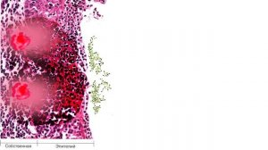 Дифтерия, ангины  - лекция