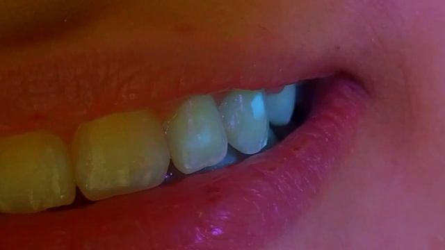 The use of UV light (Black light) in aid to remove remnants in composite after bracket removal смотреть онлайн