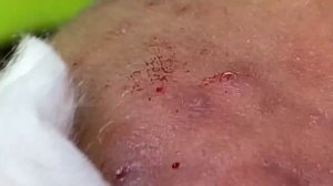 ACNE CLEANING RELAX - KINISH TV  #45
