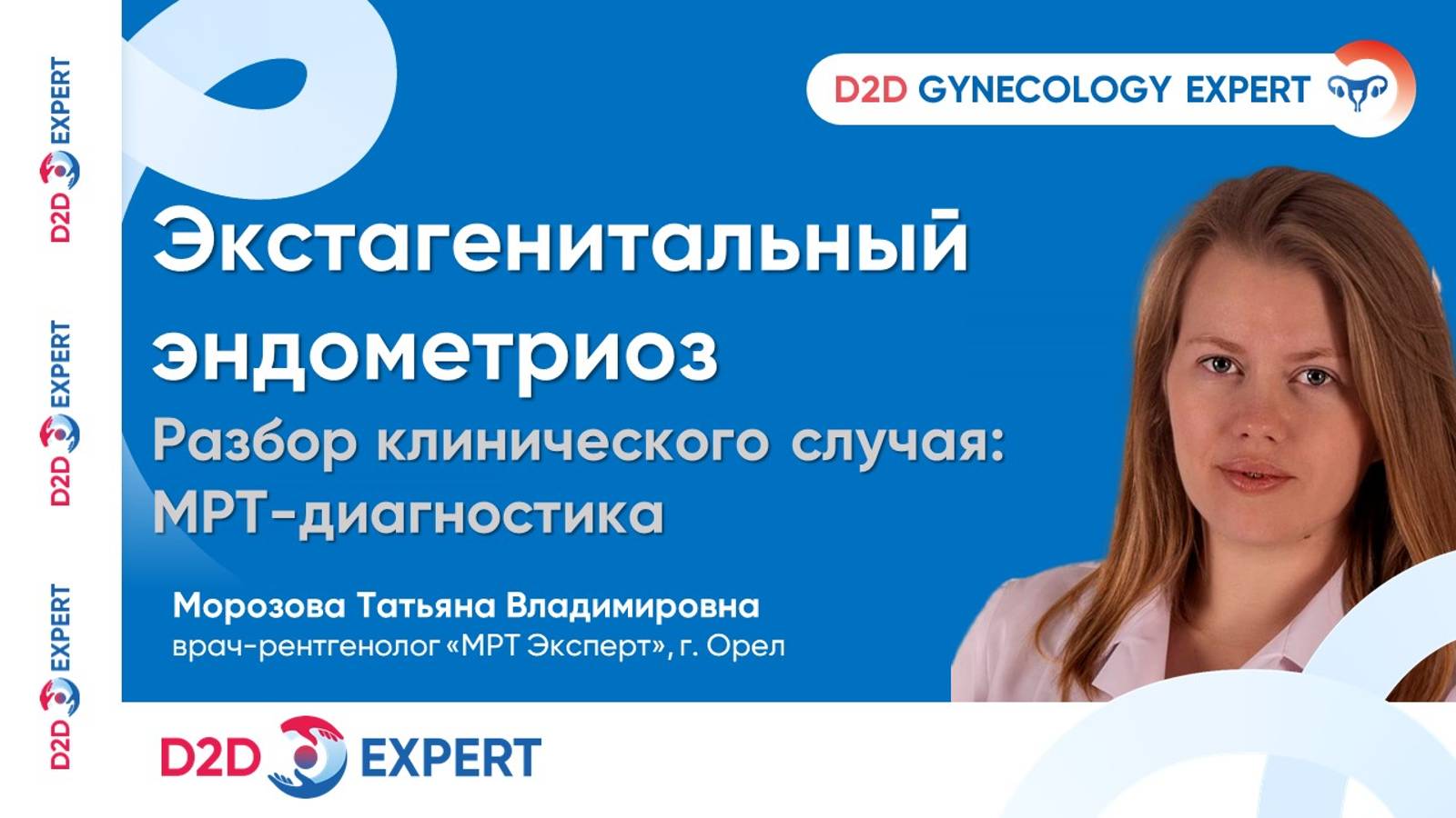 Экстагенитальный эндометриоз. МРТ случай