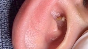 Прыщи / Огромные прыщи / Релакс с акне / Выдавливание прыщей / Черная точка  #Прыщи