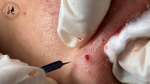 Huong Da Nang Acne Treatment #347