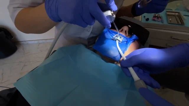 Отбеливание зуба. Повторный прием и окончание процедуры. смотреть онлайн