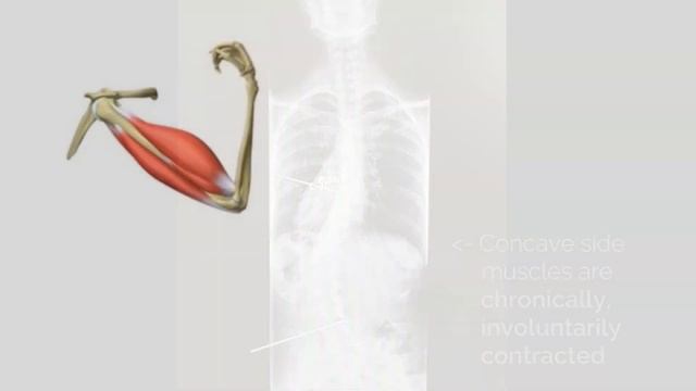 How Muscles Contract in Scoliosis C Curve смотреть онлайн