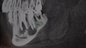 Компьютерная томография (КТ) в стоматологии: развод на деньги? | 3D диагностика челюсти и зубов