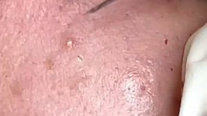 Relax squeezing out blackheads Spa TV #18 Черные точки