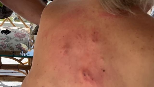 EXTREME CYST & PIMPLE EXPLOSION UNDER PRESSURE