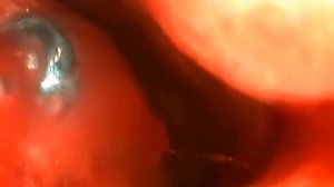 Лазерная вазотомия