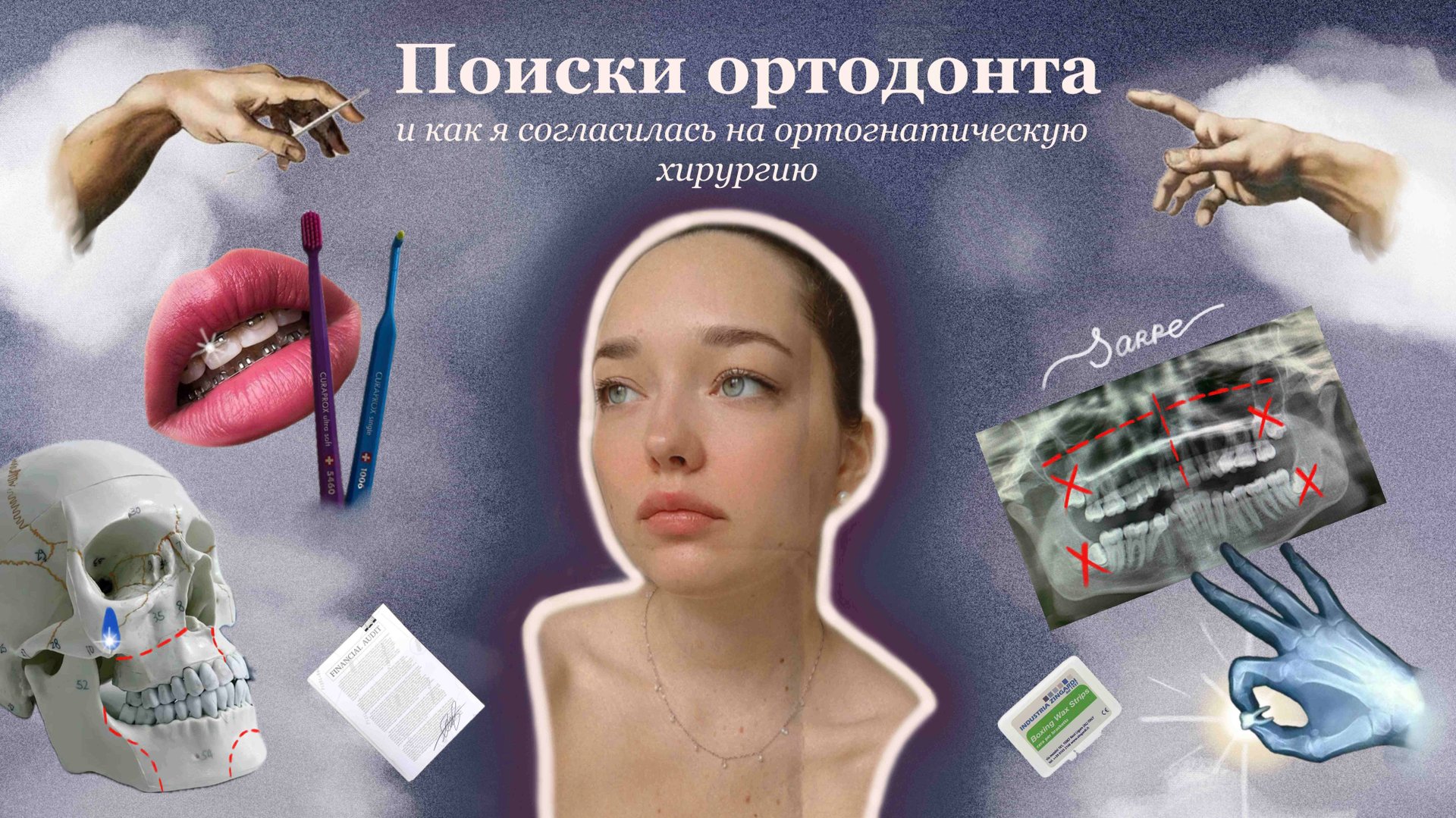 Выбор ортодонта, SARPE и ортогнатическая операция. Как все начиналось