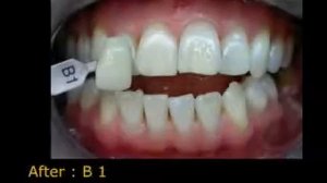 Отбеливание зубов, впечатляющие результаты