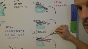 Катетеризация подключичной вены по анатомическим ориентирам (vena subclavia).