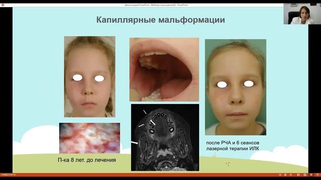 Мальформация кровеносных сосудов у детей на лице, голове и шее смотреть онлайн