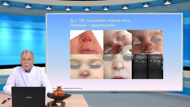 Ошибки и осложнения в лечении детей с поражением кровеносных сосудов головы и шеи (Рогинский В.В.) смотреть онлайн