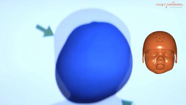 Ортопедический шлем смотреть онлайн