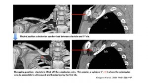 Катетеризация внутренней яремной вены по анатомическим ориентирам (venae jugulares).