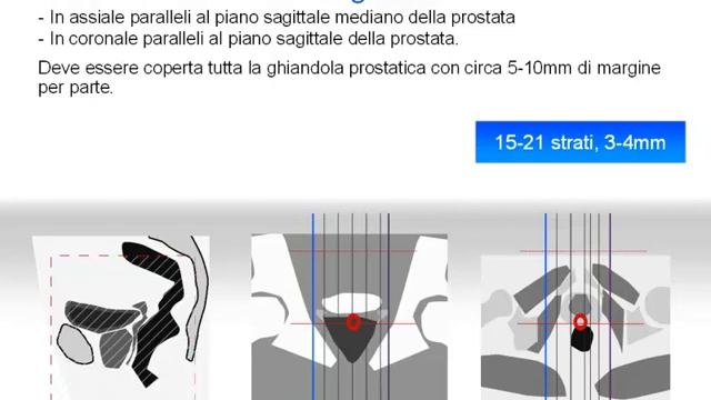 Corso RM FAD 2015 - prostata parte 1 смотреть онлайн
